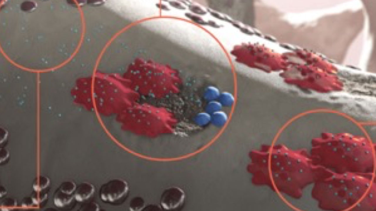 Mechanism of Action how XGEVA® blocks the function of RANK ligand (RANKL) in solid tumors video